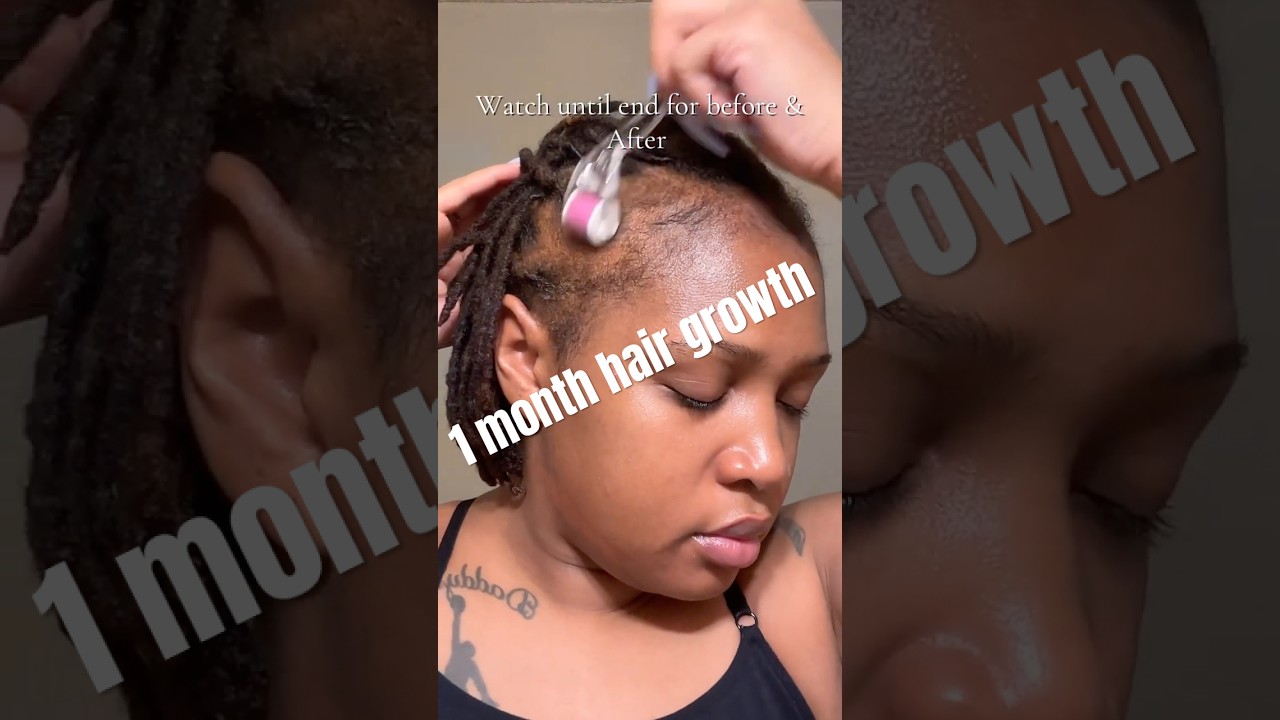 1 month Hair growth journey! #minoxidil #hairgrowth #hairgrowthchallange #baldinghair #hairloss