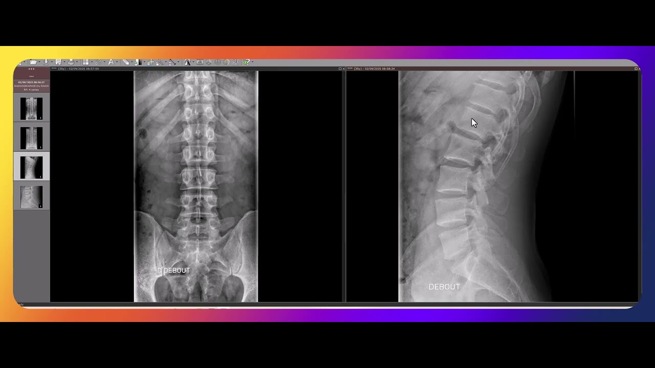Comment interpréter une radiographie du rachis lombaire ?