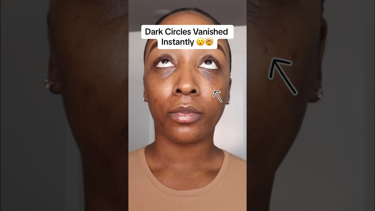 Dark circles Vanished Instantly 😮🤯 #darkcircles #darkcirclesundereyes #makeuphack