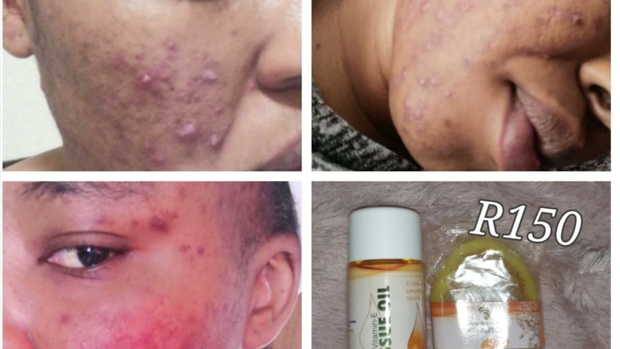 Fight pimples, stretch marks, acne, blemishes and Eczema with Umgalelo #Skincare #Umgalelo Products