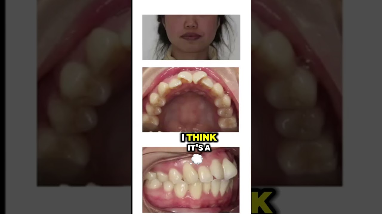 Invisalign: How to correct severe crowding/protrusion & create smiles WITHOUT extractions or braces!