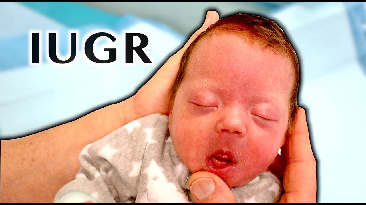 RARE INTRAUTERINE GROWTH RESTRICTION (IUGR) | Dr  Paul