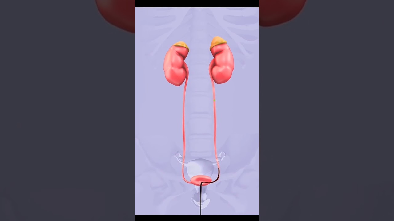 3D kidney stone removal - Lithotripsy procedure #shorts #lithotripsy #renalstone