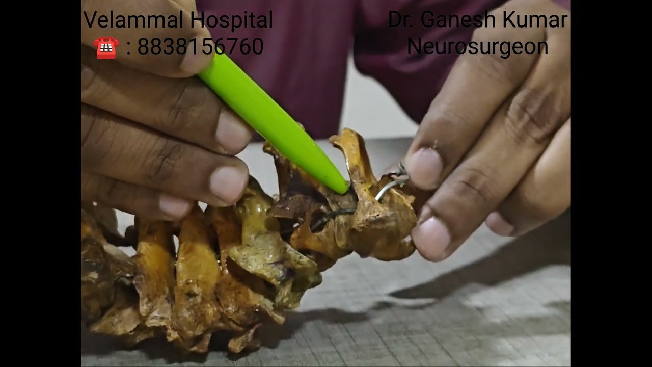 C1-C2 Screw Fixation