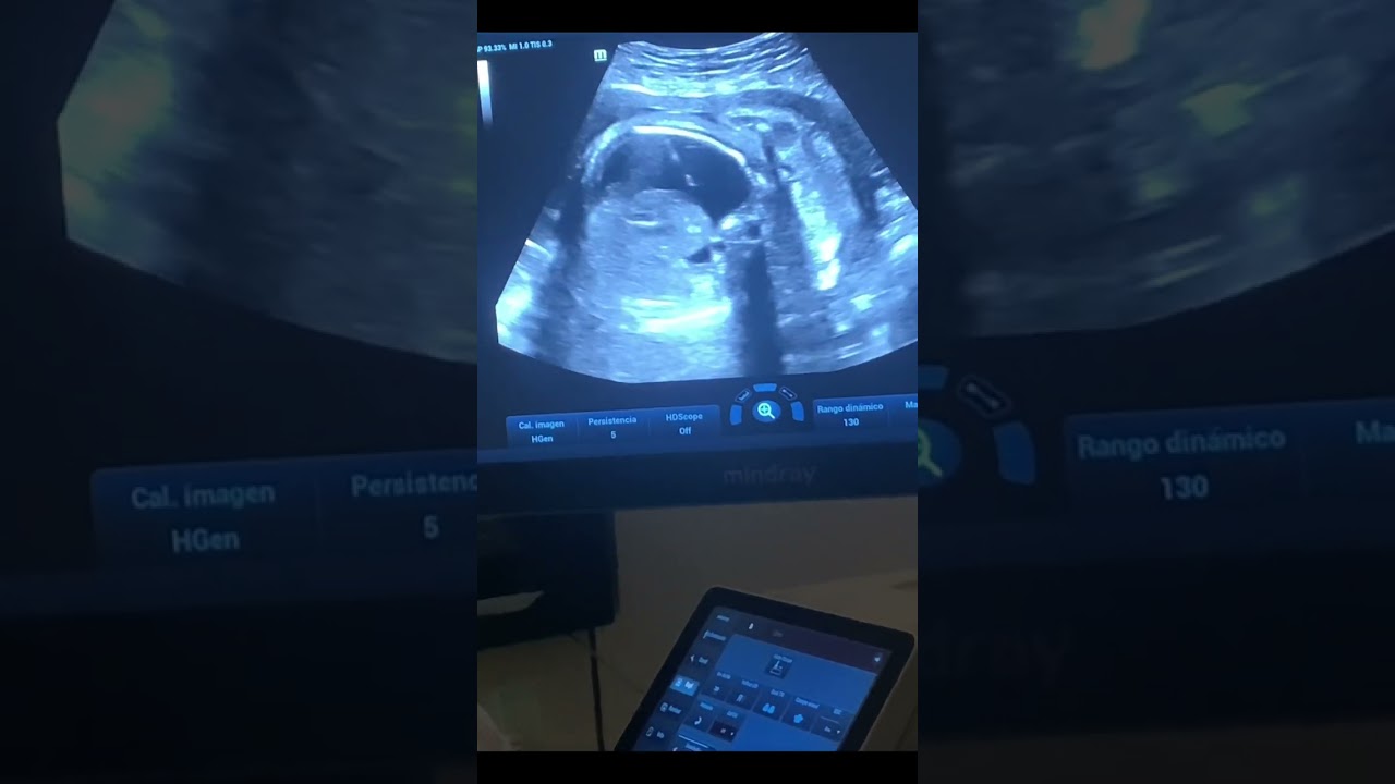 TORACOCENTESIS fetal, hidrotorax fetal primario. #toracocentesisfetal #unifetal #perinatologo
