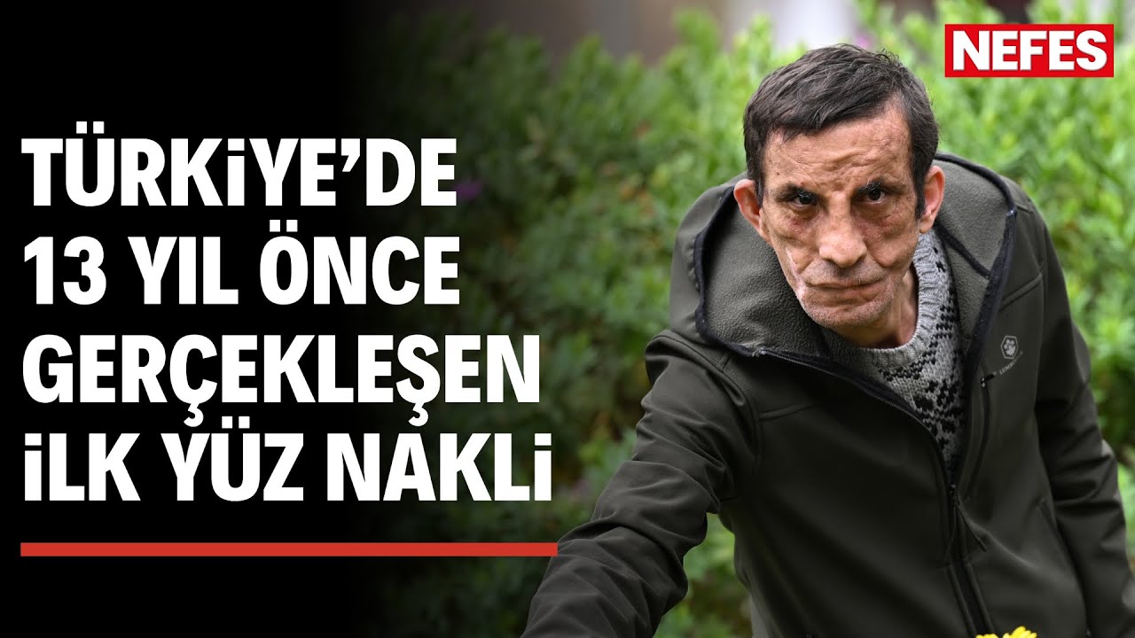 Türkiye'de ilk yüz nakli olan Uğur Acar, 13 yılda hayallerine de kapı araladı