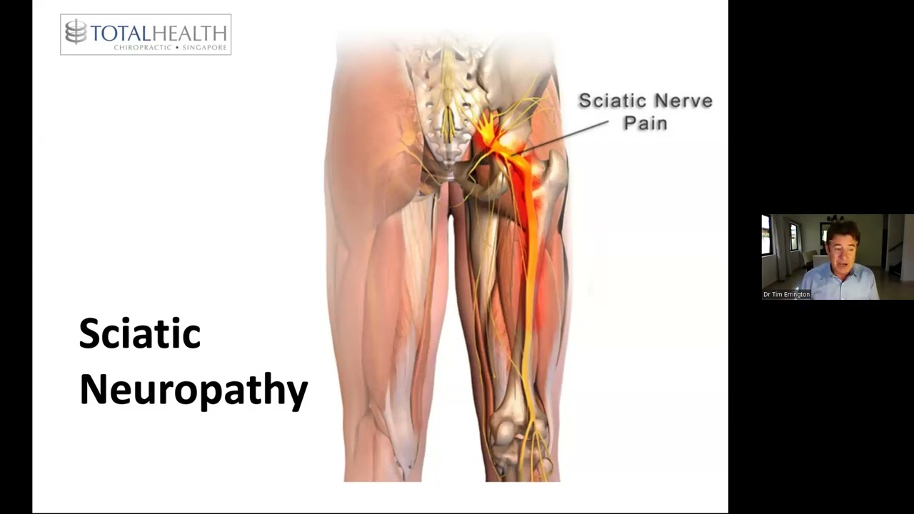 Everything you need to know about sciatica!