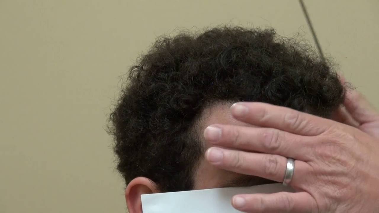 Hair Restoration Surgery Results FUE 2000 Grafts Black Before/After  Dr. Diep www.mhtaclinic.com