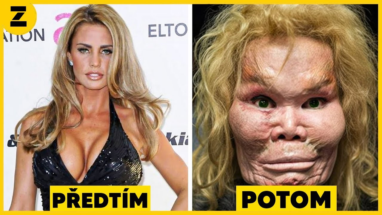 15 Celebrit, Kter&yacute;m Plastick&aacute; Chirurgie Dopadla Katastrofou