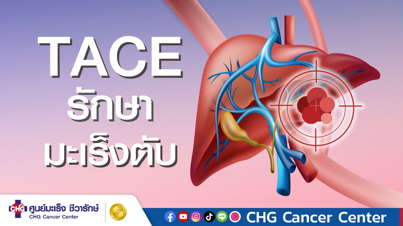 TACE คืออะไรไปดูกัน  #รู้เร็วรักษาได้ #รักษามะเร็ง #ศูนย์มะเร็ง #cancer