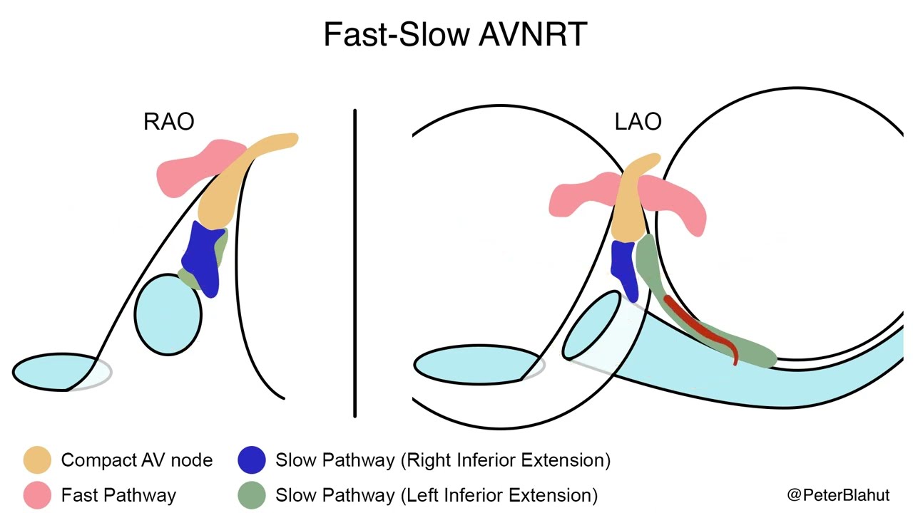 AVNRT (Slow-Fast, Fast-Slow, Slow-Slow) - Ablation Targets