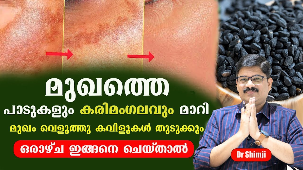 മുഖത്തെ പാടുകളും കരിമംഗലവും മാറി മുഖം വെളുത്തു കവിളുകൾ തുടുക്കും karimangalam treatment in malayalam