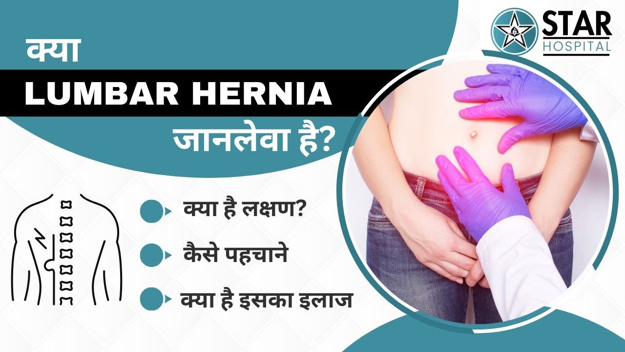 Lumbar Hernia in Hindi - Causes, Symptoms, Tests, Exercises & Treatment | Laparoscopic Management