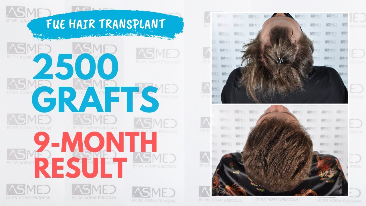 Manual FUE Hair Transplant Before & After 2500 Grafts 9-Month Result - ASMED - Dr. Koray Erdogan
