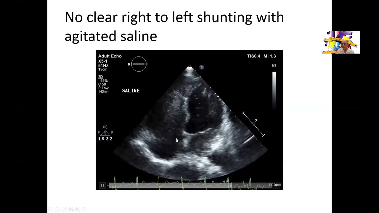Rare form of Atrial Septal Defects and Review of ASDs