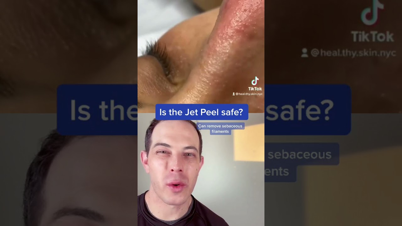 Crazy way to remove blackheads? Jet Peel Demo | 208SkinDoc