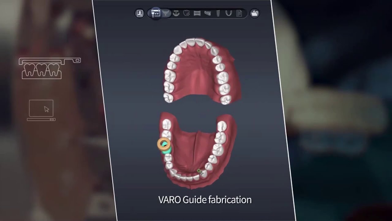 VARO Guide - New Digital Implant Guide System
