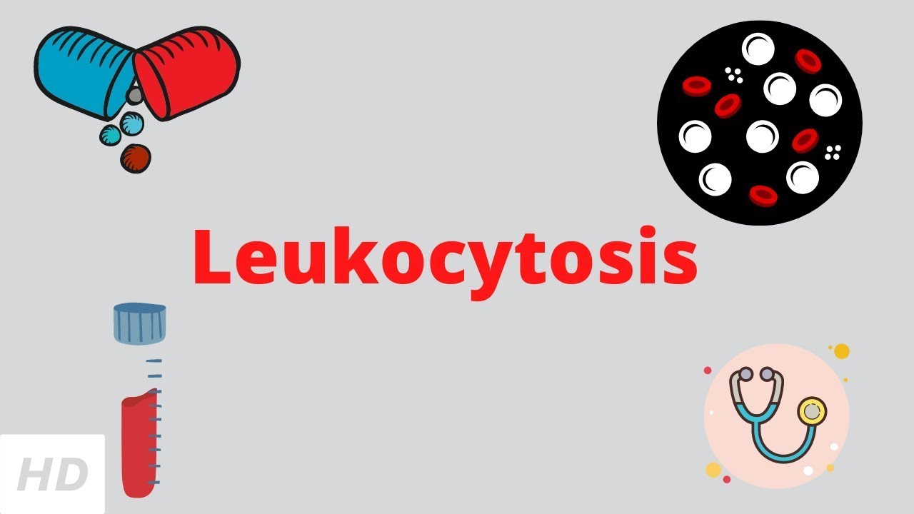 Leukocytosis, Causes, Signs and Symptoms, Diagnosis and Treatment.