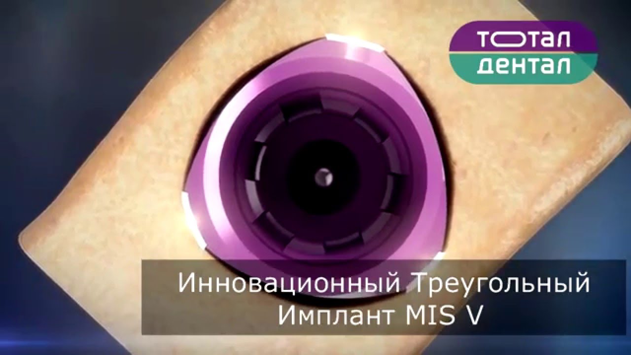 Стоматология Тотал Дентал Киев New Имплант Mis V3
