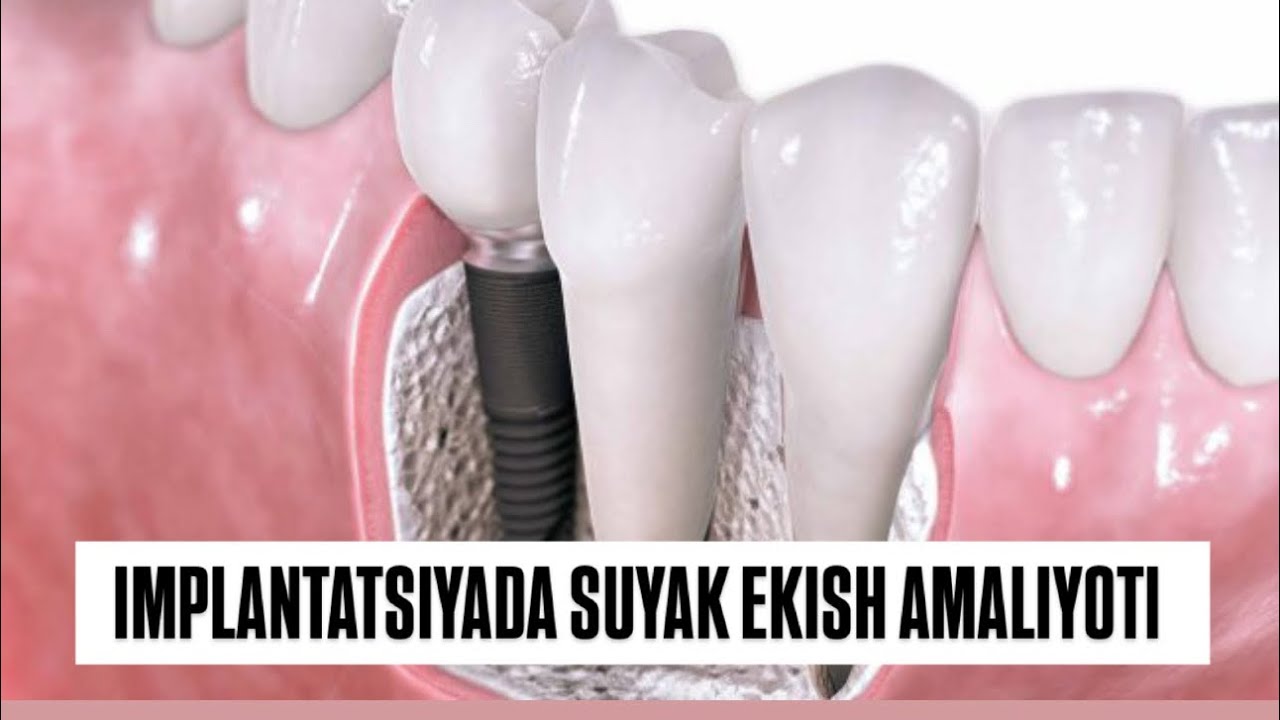 Implantatsiyada suyak ekish amaliyoti ❗️. #dentist#shifokor#smile#tibbiyot#doctor#dentistry
