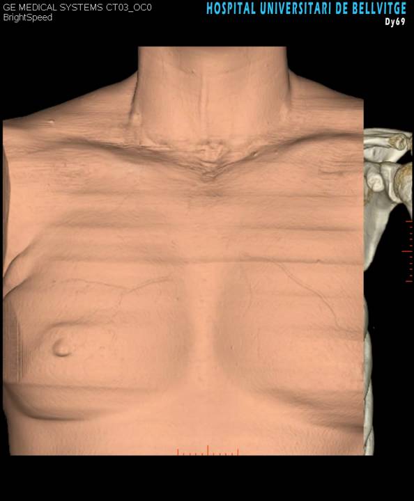 IVAMS - Cirugia Paratiroides ectopico