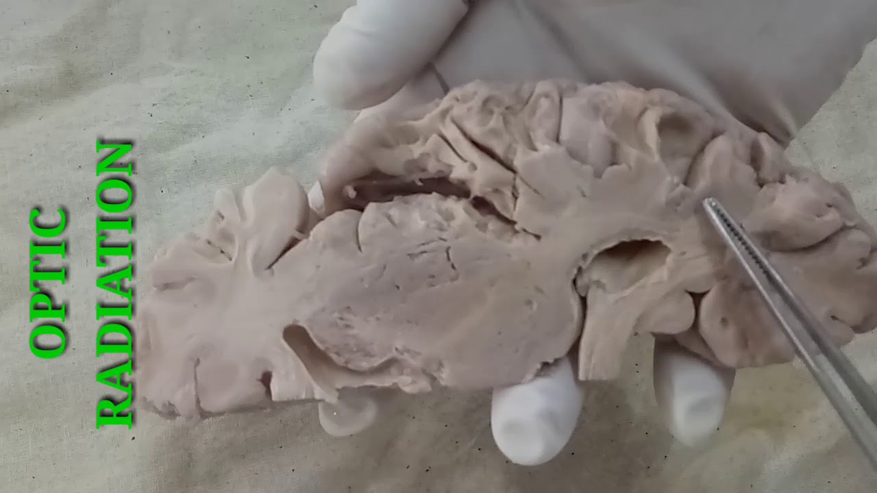 NEUROANATOMY - HORIZONTAL SECTION OF CEREBRUM - BY DR MITESH DAVE