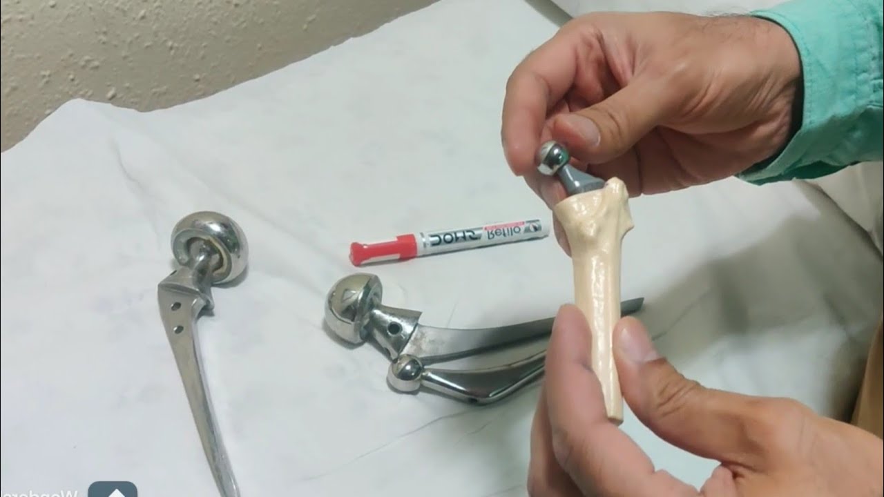 Selection of Implants in Revision Hip Replacement