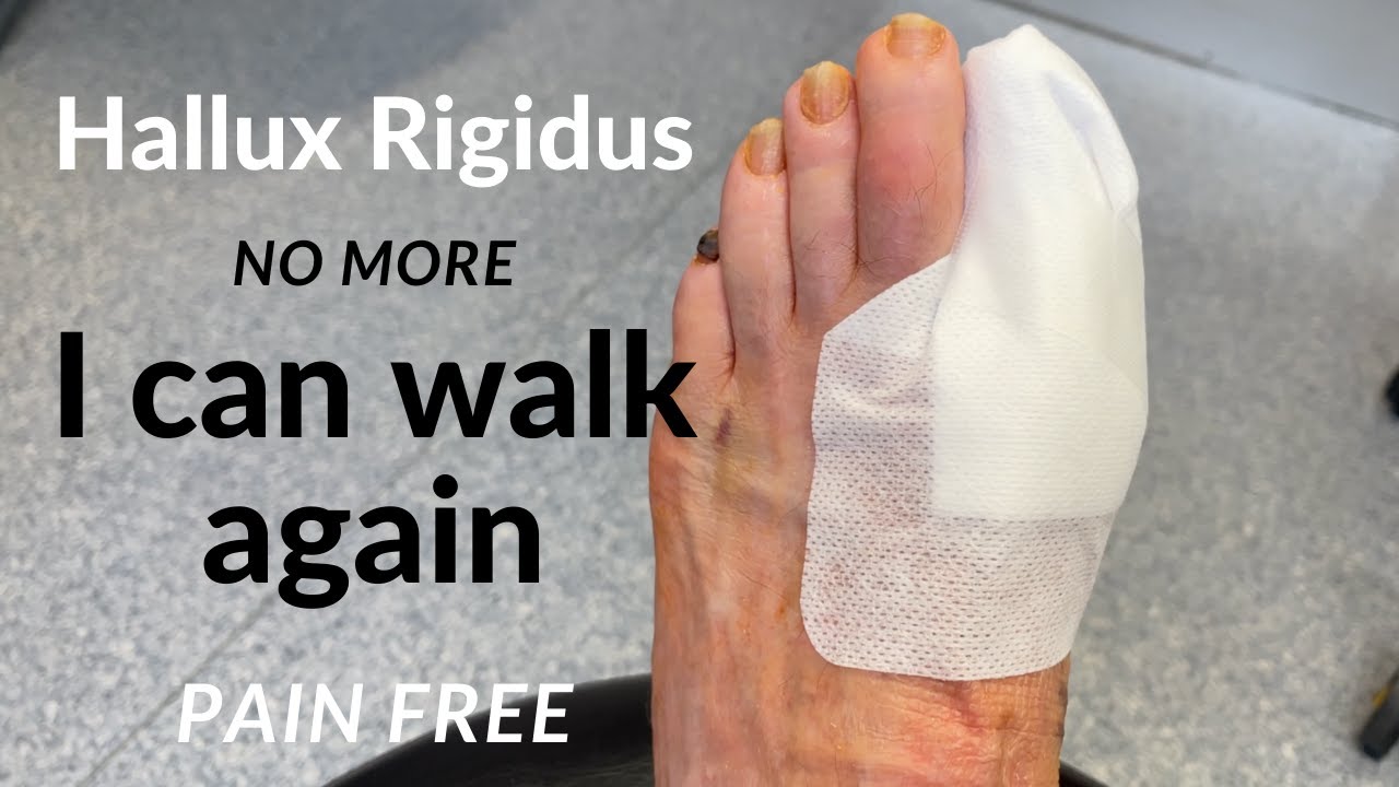 Hallux Rigidus Больше Нет