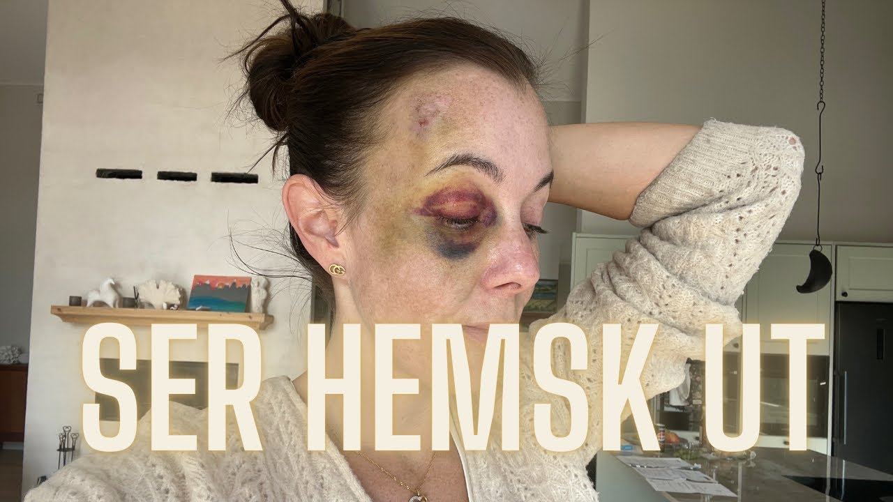 Ser hemsk ut, folk måste undra - VLOGG