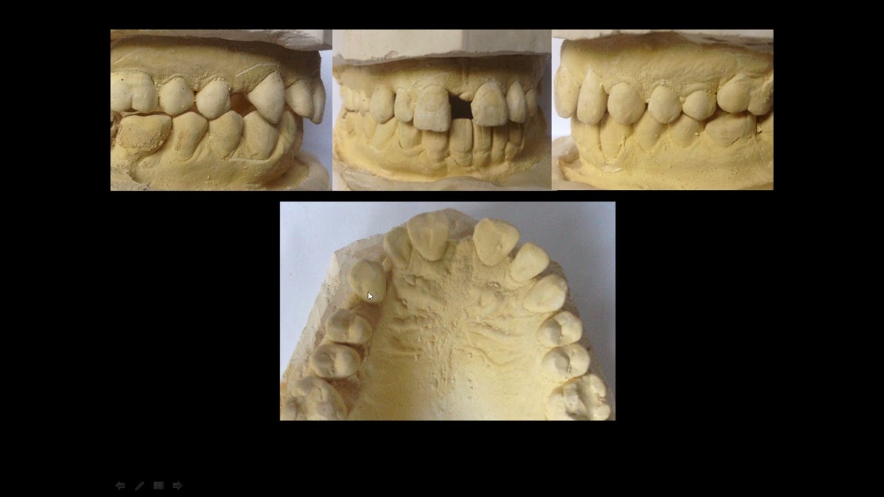 The Role Of Orthodontics In Implant Site Development . Prof Ghassan Dandachli