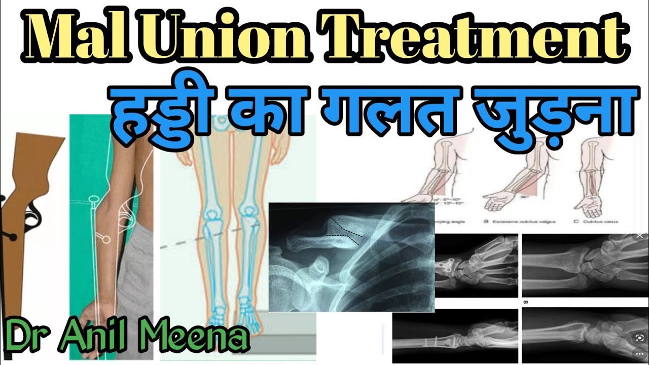 mal union fracture treatment | हड्डी का गलत जुड़ जाने पर इलाज | mal union treatment | in hindi