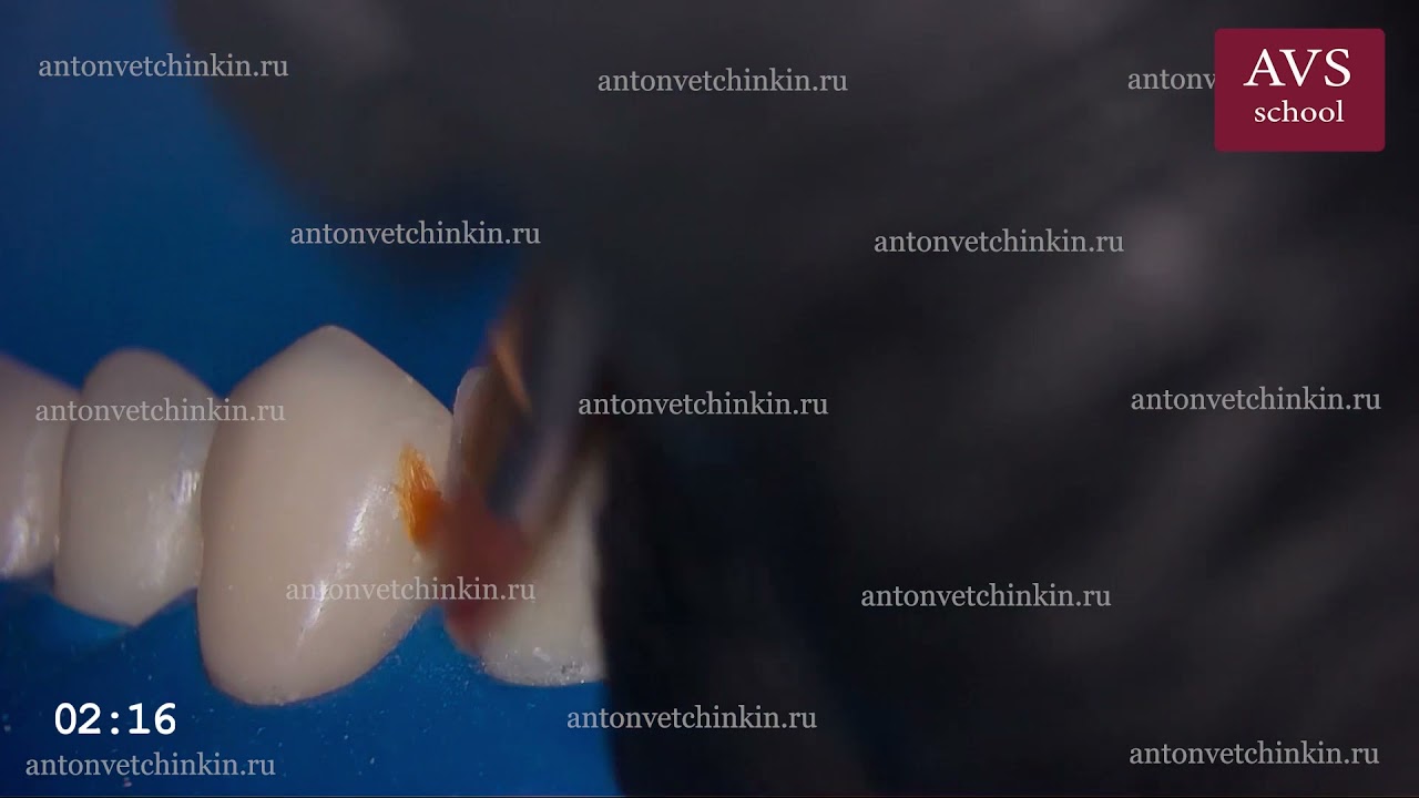 Формирование аппроксимальной стенки латерального резца (часть №3)
