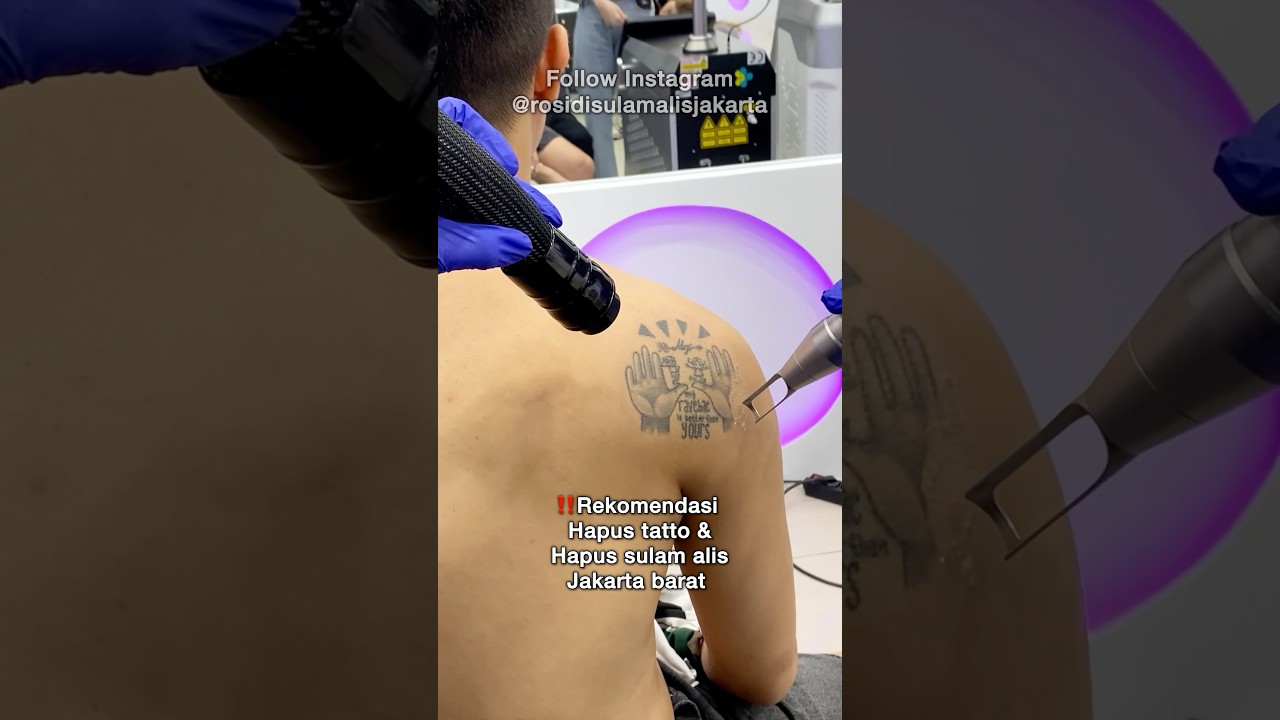‼️Hapus tatto murah di jakarta menggunakan alat canggih #sulamalisrosidi