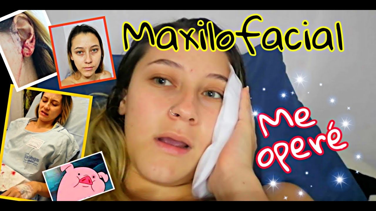 CIRUGÍA MAXILOFACIAL | ortognática | MI EXPERIENCIA | Alisson Ríos B | cirugía primero