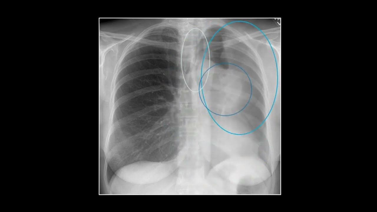 Emergency Pulmonary Radiographs | 15 Minute Radiology CME