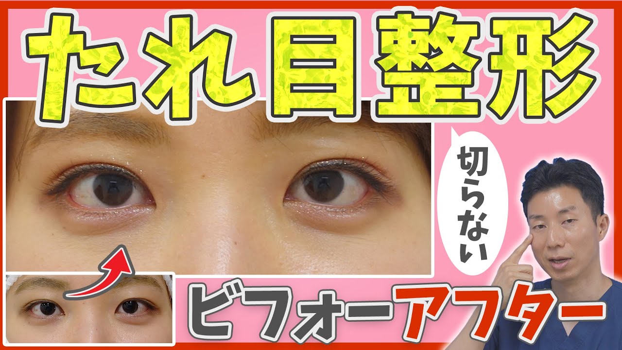 【たれ目整形】切らずにどこまでタレ目にできる？