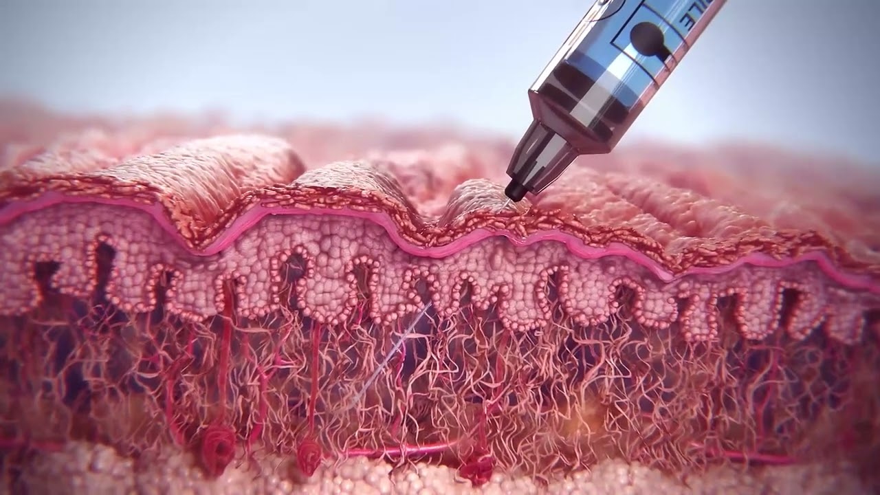 How Sculptra Works