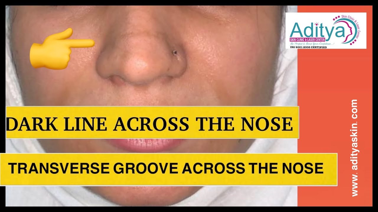 DARK LINE ACROSS THE NOSE | PIGMENTATION ON NOSE | TRANSVERSE NESAL GROOVE | LASER TREATMENT by DR .
