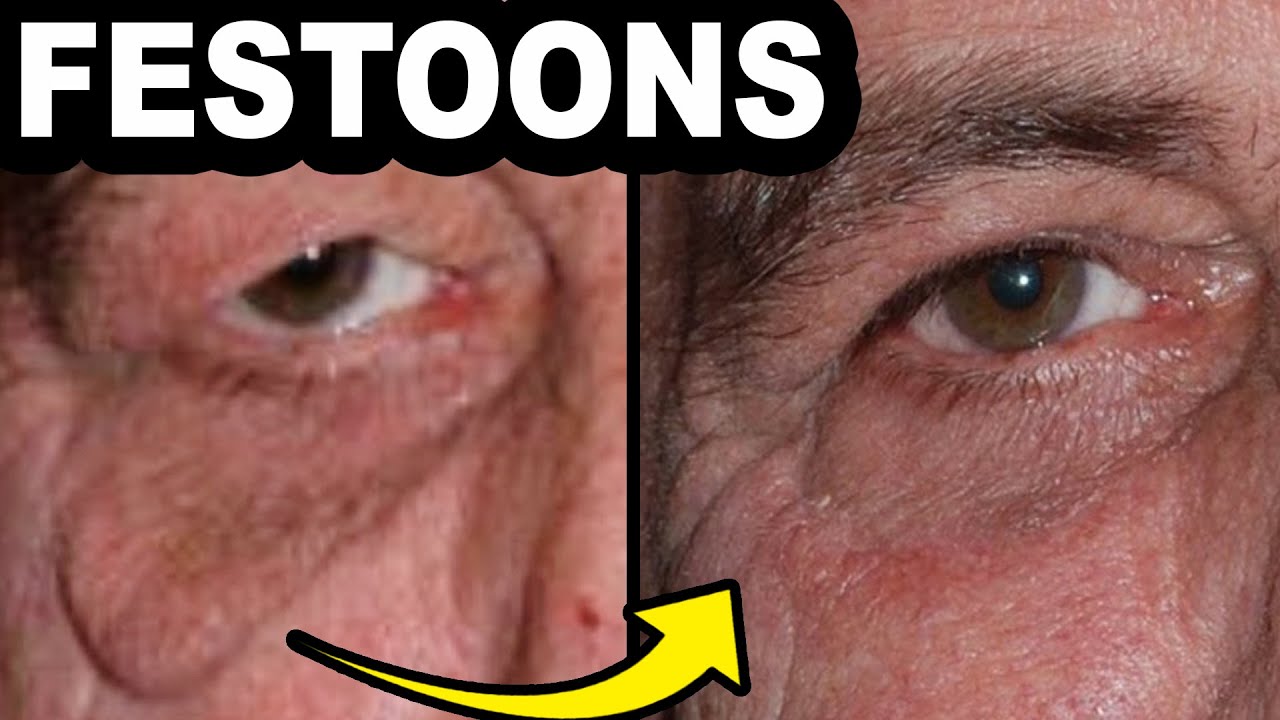 How do I get rid of FESTOONS on my face? Plastic Surgeon Answers