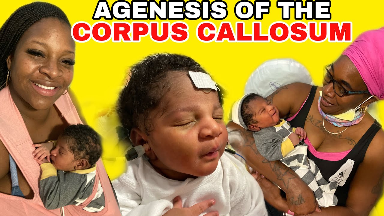 COME WITH PEACH 🍑 MY 6th CHILD IN THE NICU 👶🏾 AGENESIS OF THE CORPUS CALLOSUM (MISSING BRAIN) 🧠