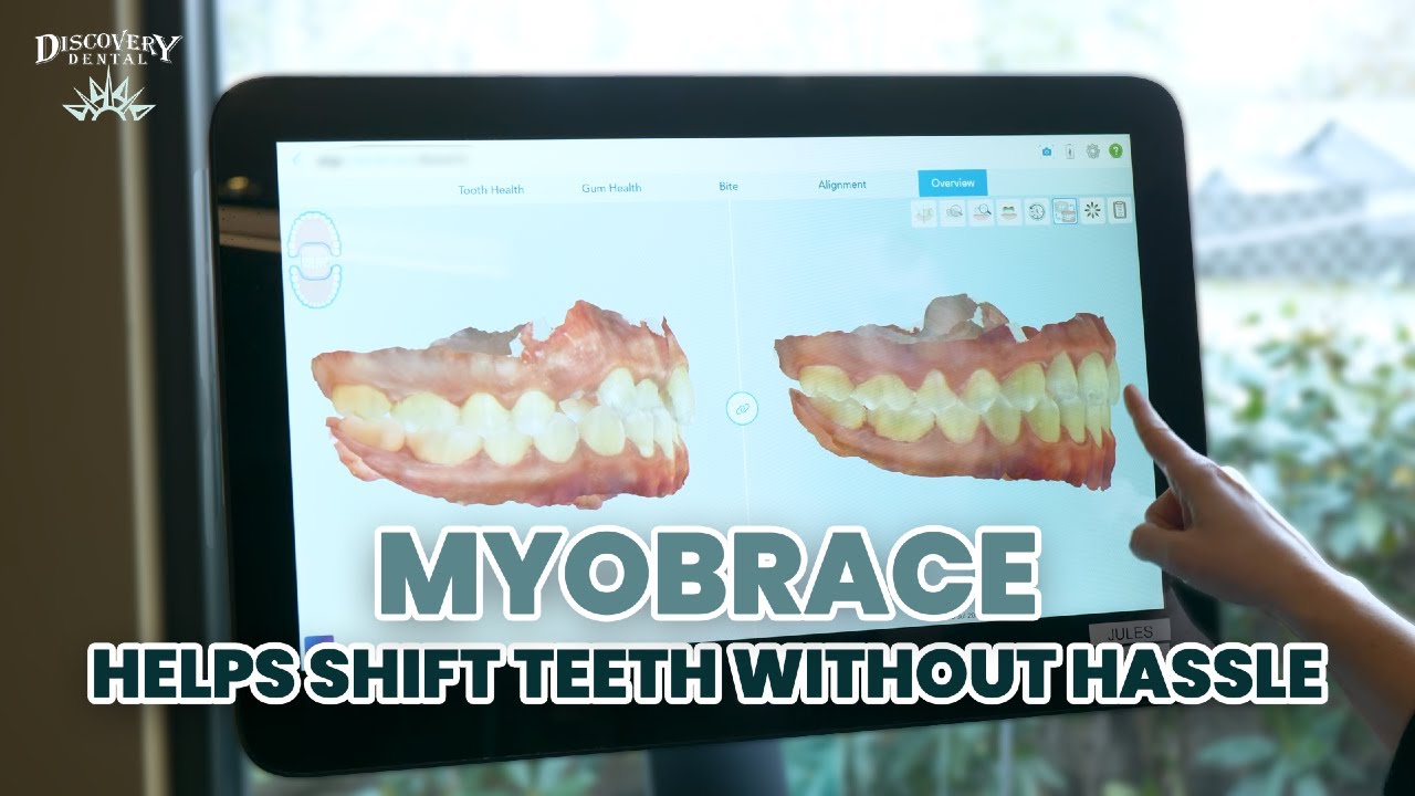 Myobrace