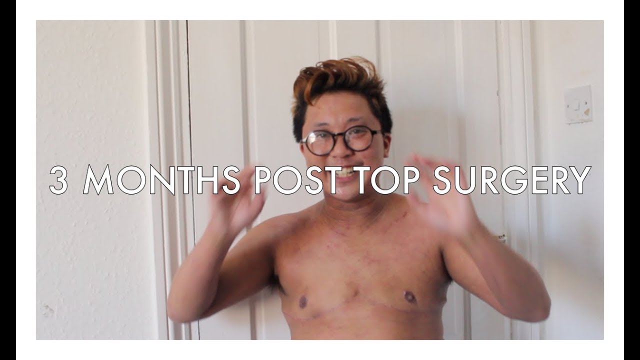 3 Months Post Top Surgery