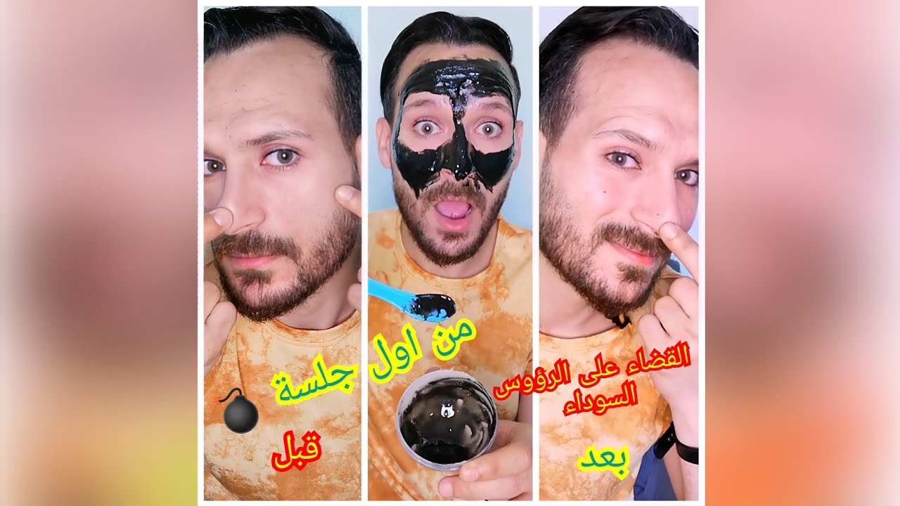 ضاع من عمرنا سنين انه مفيش حل لازالة #الرؤوس_السوداء و #ازالة_شعر_الوجه غير بالليزر او بالفتلة 3X1 💃
