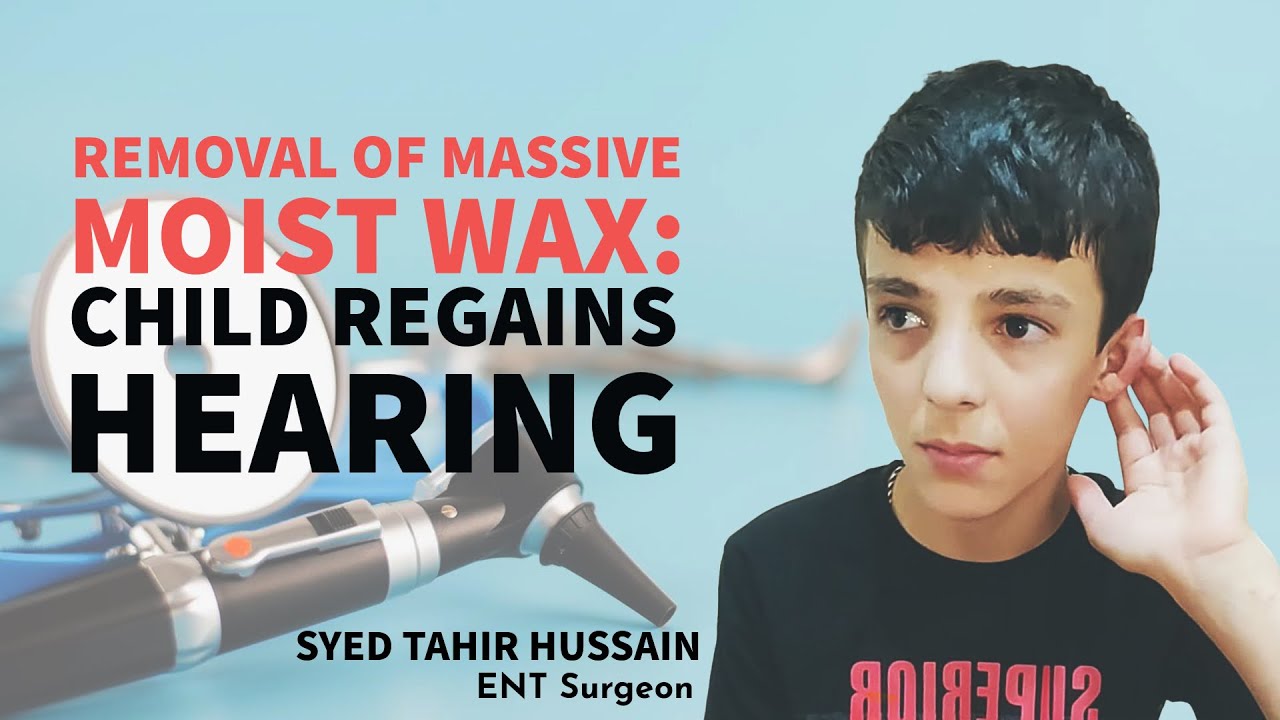 Child&rsquo;s Hearing Restored||After Removal of Massive Ear Wax || Foreign Body ||