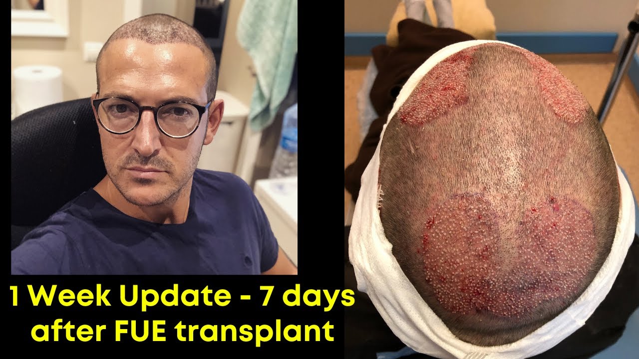 7 Days After FUE Hair Transplant in Turkey - 1 week update