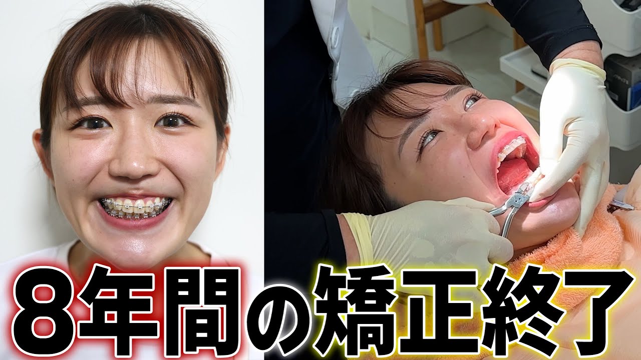【矯正終了】ついに8年続いた歯の矯正が終わりました
