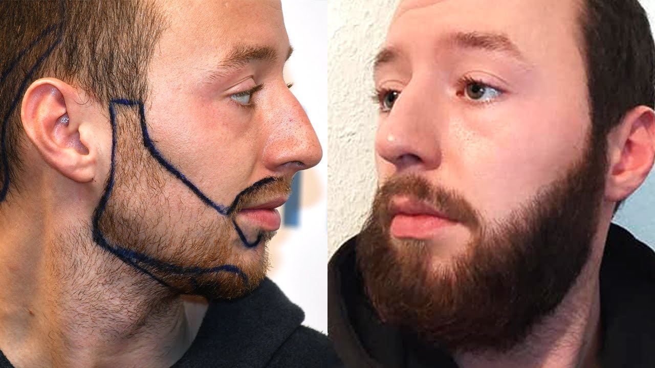 Trasplante de barba antes y después - Recorrido desde el día 1 a los 13 meses #7