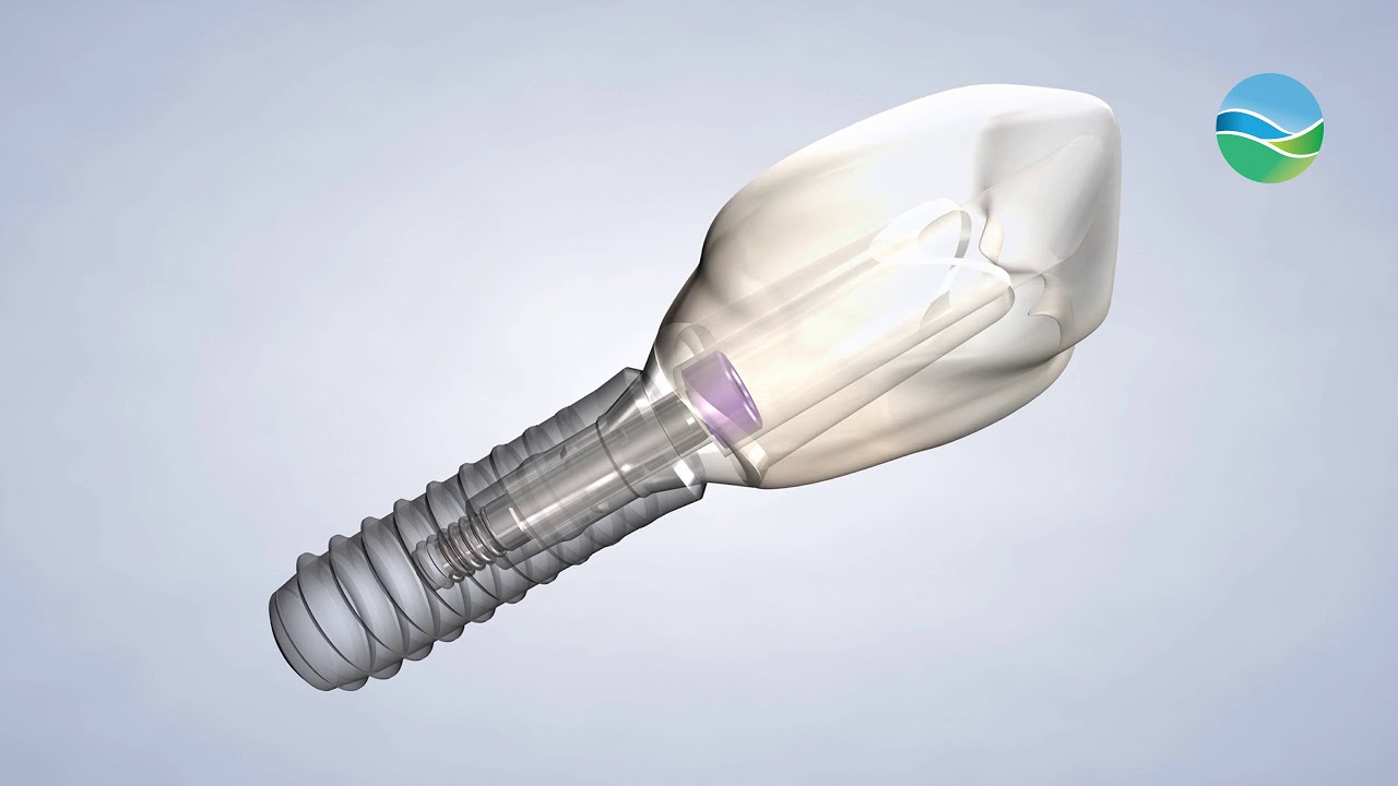 Post-Operative Instructions: Dental Implants at Southern Oral & Facial Surgery in Franklin, TN