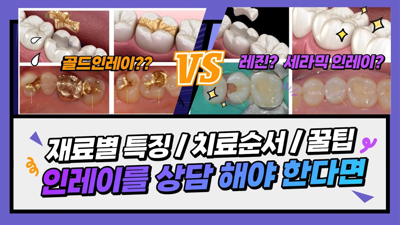 인레이(Inlay)치료 재료별 특징 / 치료방법 / 꿀팁