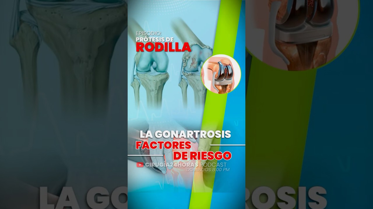 LA GONARTROSIS – FACTORES DE RIESGO 🦵⚠️